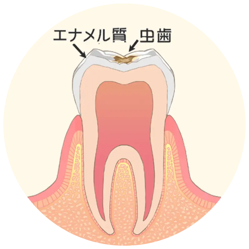 歯の表層（エナメル質）の虫歯