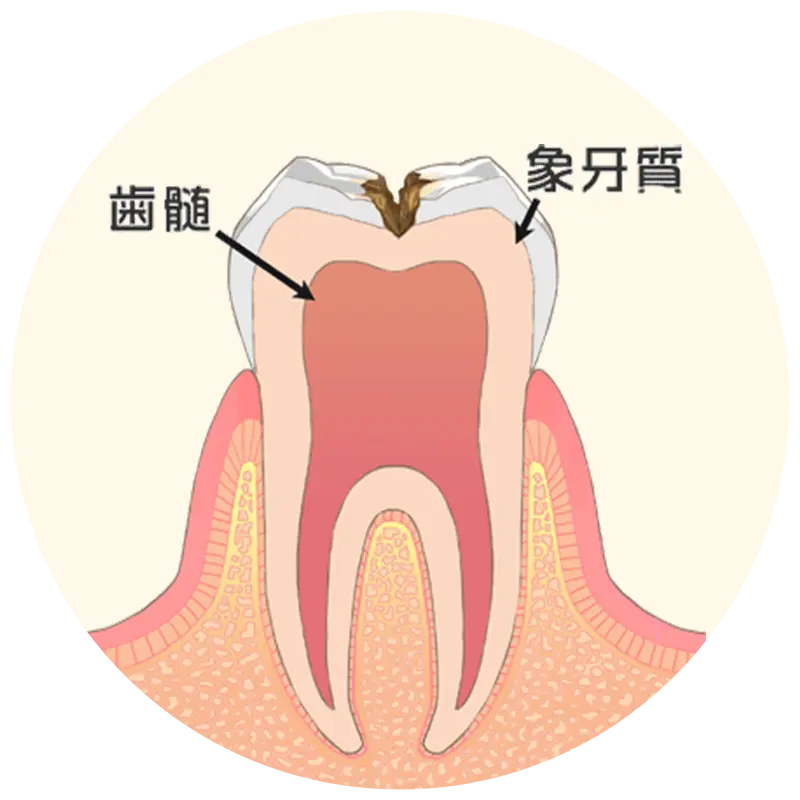 歯の中（象牙質）まで進んだ虫歯