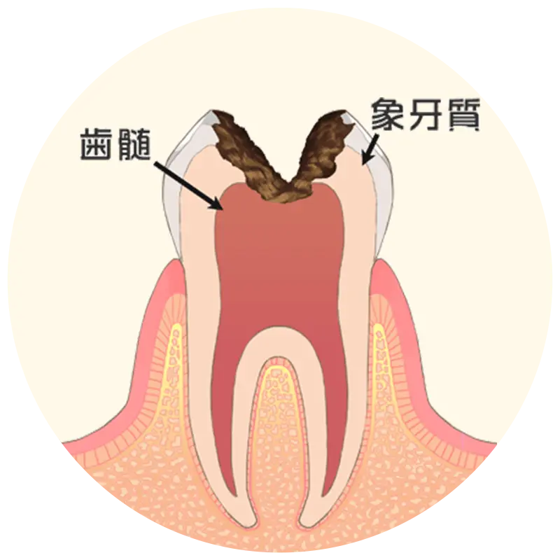 歯の神経まで達した虫歯