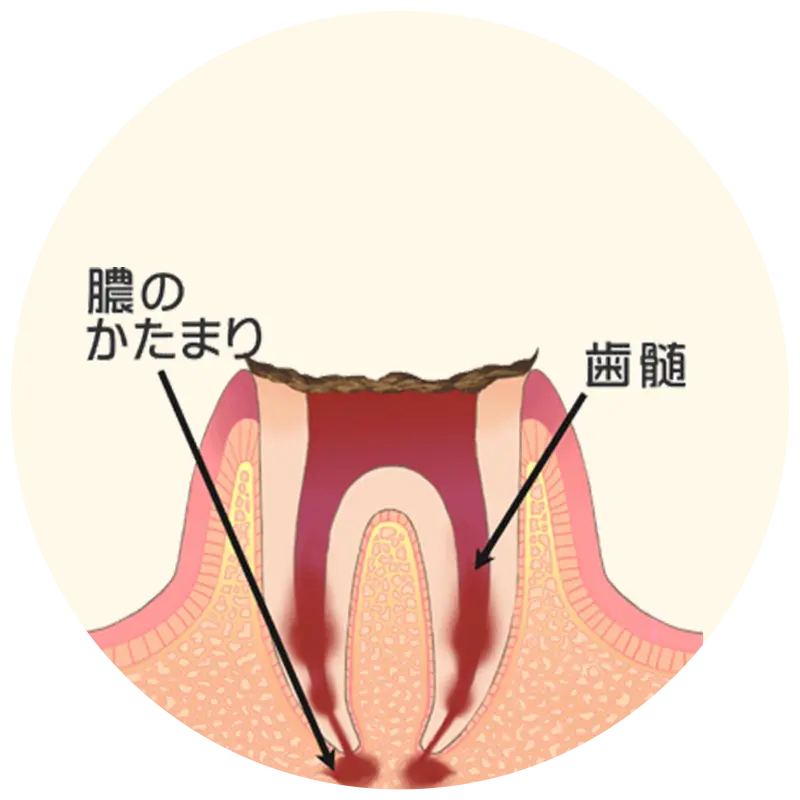 歯の根っこまで達した虫歯