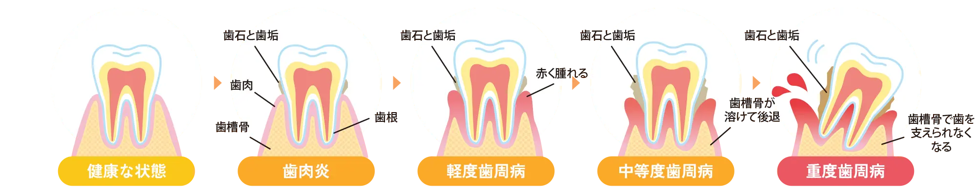 歯周病の進行