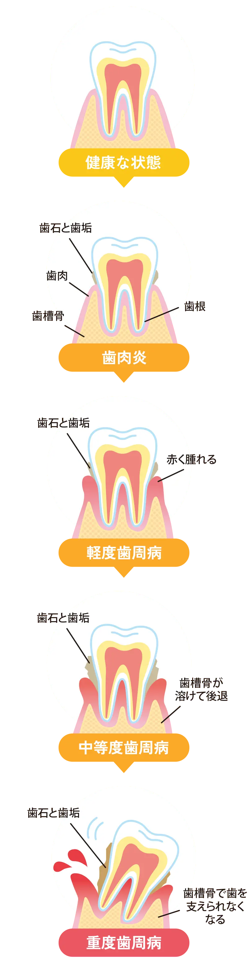歯周病の進行