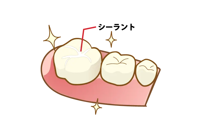 シーラント